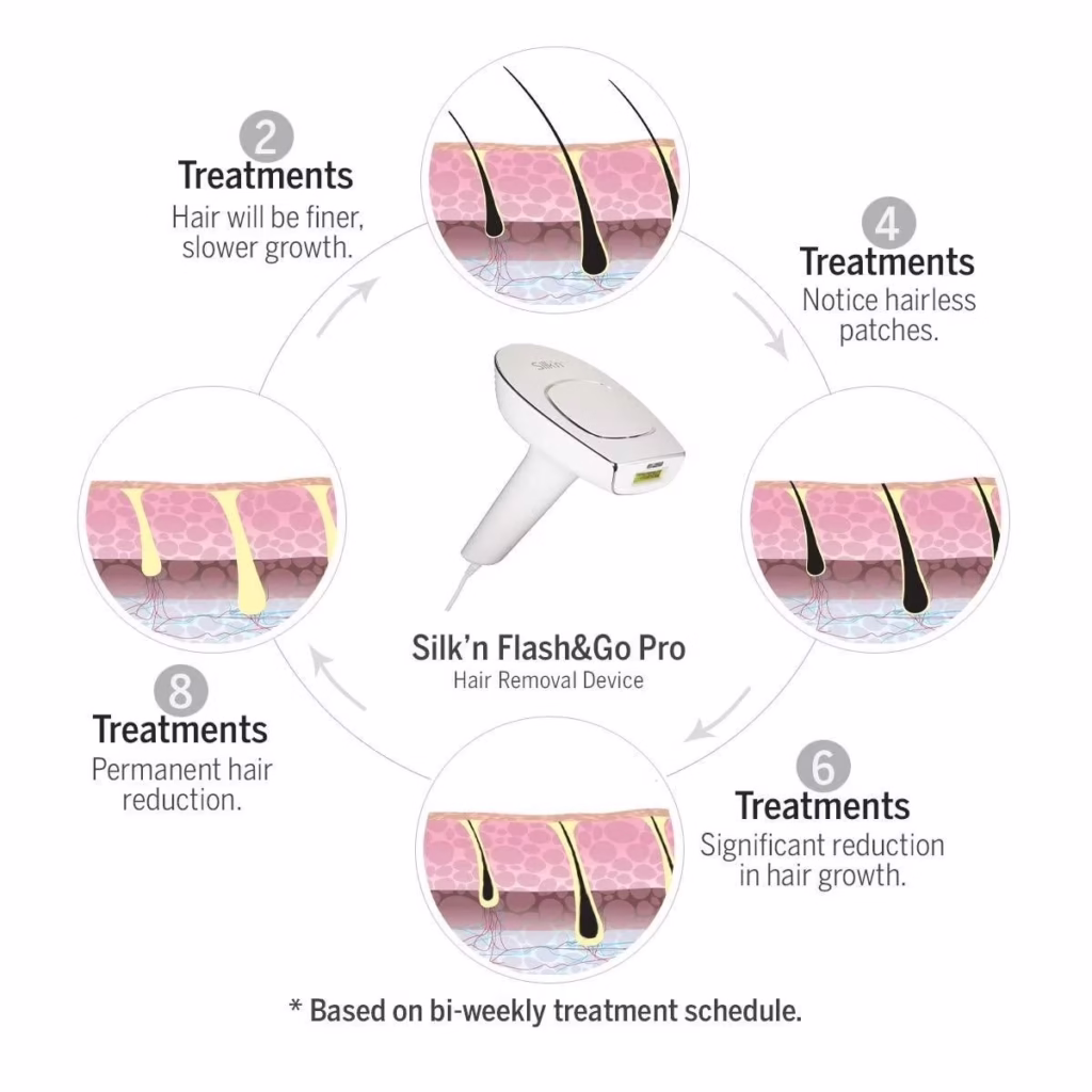 Silk'n Flash & Go Pro IPL hair removal device treatment cycle results